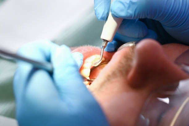 Best Emergency Wisdom Teeth Removal in Augusta, KS